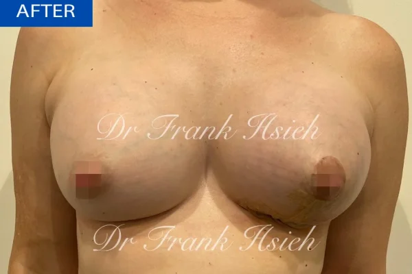 Breast Mastopexy/ Augmentation Case 1 After