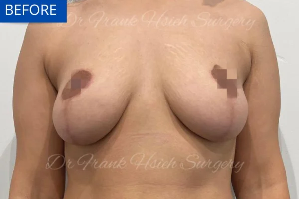 Breast Mastopexy/ Augmentation Case 1 Before