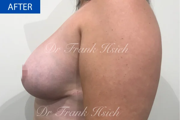 Breast Mastopexy/ Lift + Augmentation Case 2. L) Side After