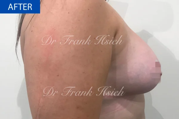 Breast Mastopexy/ Lift + Augmentation Case 2. R) Side After