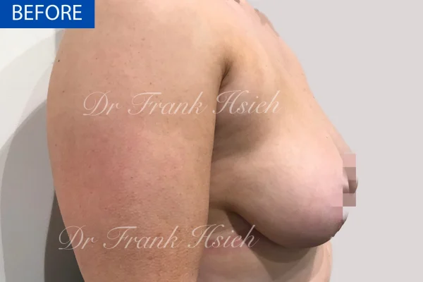 Breast Mastopexy/ Lift + Augmentation Case 2. R) Side Before