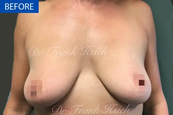 Breast Mastopexy/ Lift + Augmentation Case 3 Before