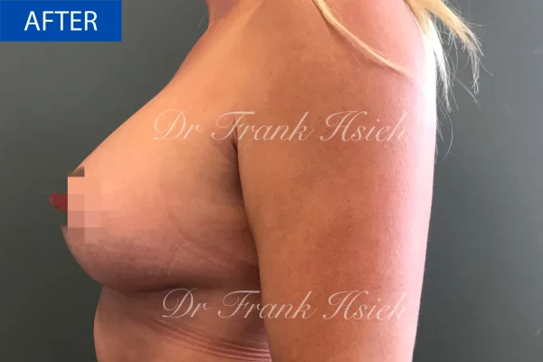 Breast Mastopexy/ Lift + Augmentation Case 3. L) Side After