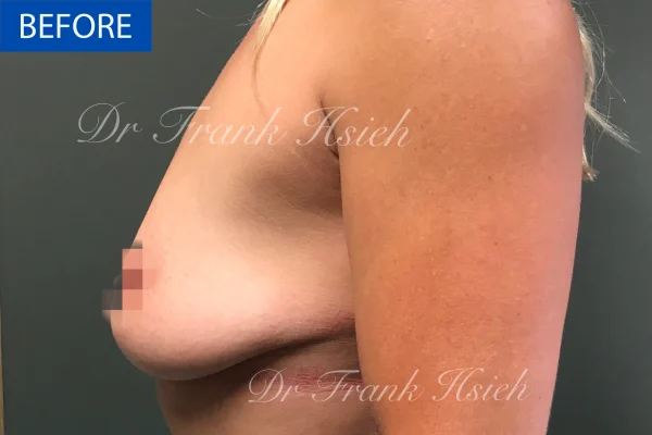 Breast Mastopexy/ Lift + Augmentation Case 3. L) Side Before