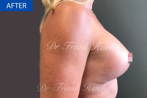 Breast Mastopexy/ Lift + Augmentation Case 3. R)Side After