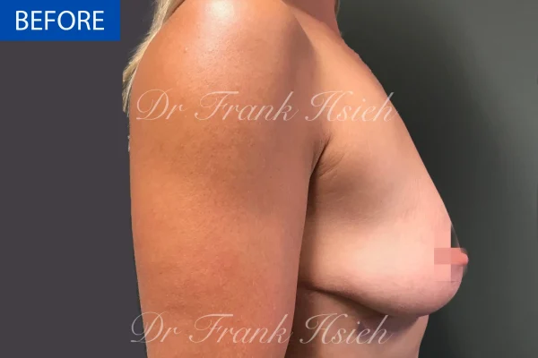 Breast Mastopexy/ Lift + Augmentation Case 3. R) Side Before